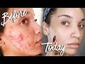 MORNING SKINCARE ROUTINE | Acne Prone Skin | RAVEN ELYSE